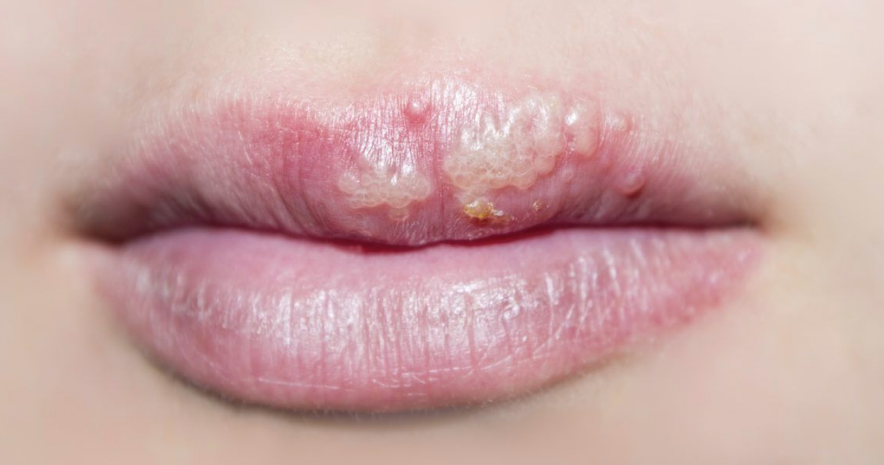 Heal A HERPES COLD SORE IN Just 2 Days Anya Vien